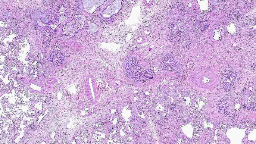 Michigan Lung slide