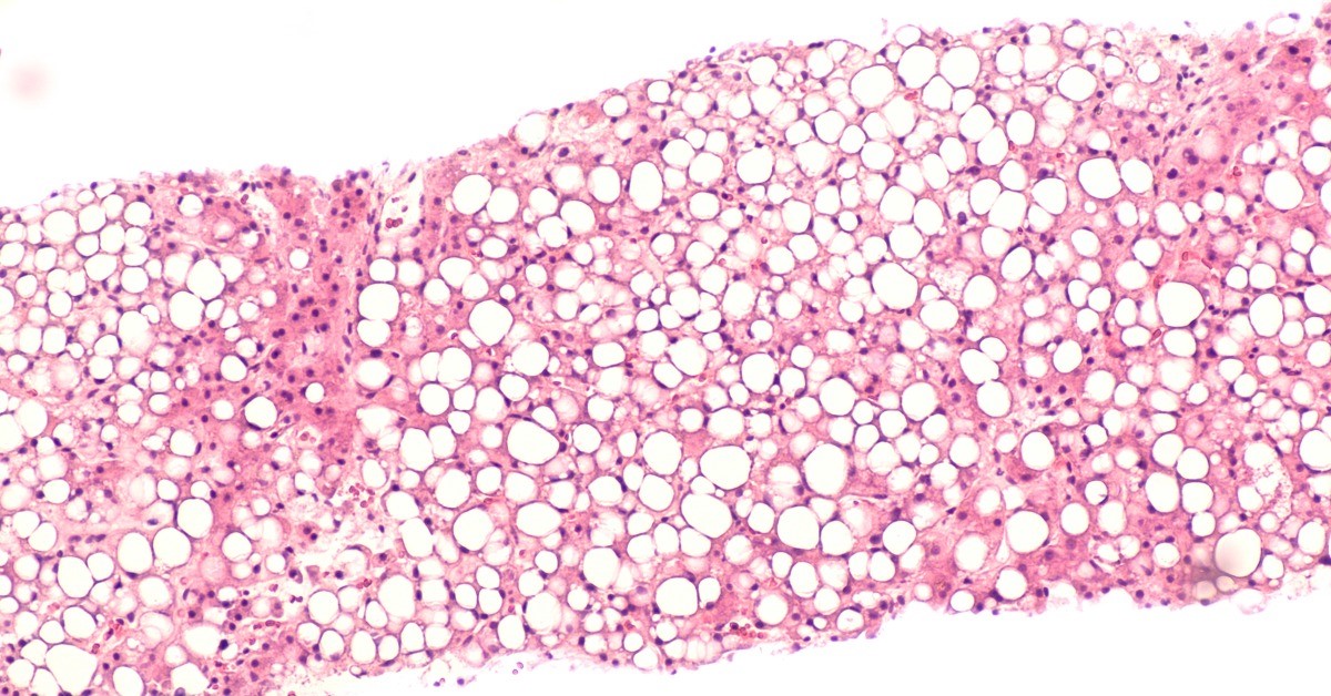 Pathology News Roundup: May 31, 2022