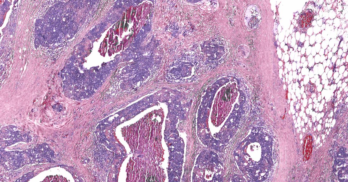 Pathology News Roundup: August 25, 2020